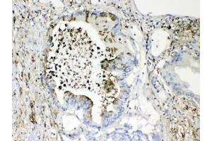 IHC testing of FFPE human intestinal cancer tissue with TMEM107 antibody at 1ug/ml. (TMEM107 anticorps  (AA 22-57))