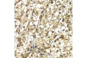 Immunohistochemistry of paraffin-embedded human kidney cancer using SULT2B1 antibody at dilution of 1:100 (x40 lens). (SULT2B1 anticorps)