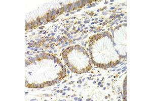 Immunohistochemistry of paraffin-embedded human gastric cancer using KISS1R Antibody (ABIN5971525) at dilution of 1/200 (40x lens). (KISS1R anticorps)