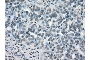 Immunohistochemical staining of paraffin-embedded colon tissue using anti-BRAFmouse monoclonal antibody. (BRAF anticorps)