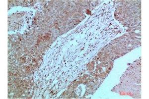 Immunohistochemical analysis of paraffin-embedded Human Breast Carcinoma Tissue using JAK2 Mouse mAb diluted at 1:2000 (JAK2 anticorps)