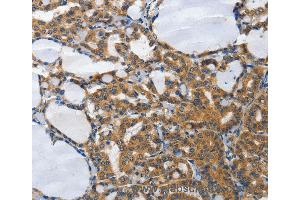 Immunohistochemistry of Human lymphoma using PIAS2 Polyclonal Antibody at dilution of 1:70 (PIAS2 anticorps)