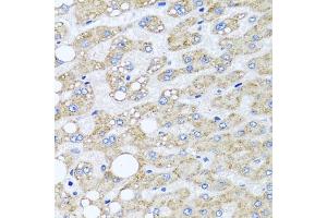 Immunohistochemistry of paraffin-embedded human liver damage using SRI antibody  at dilution of 1:100 (40x lens). (SRI anticorps  (AA 1-198))