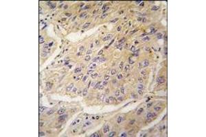 Formalin-fixed and paraffin-embedded human lung carcinoma tissue reacted with CASP3 antibody (Center), which was peroxidase-conjugated to the secondary antibody, followed by DAB staining. (Caspase 3 anticorps  (Middle Region))