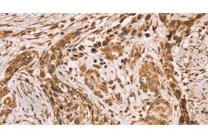 Immunohistochemistry of paraffin-embedded Human esophagus cancer using HIF1AN Polyclonal Antibody at dilution of 1:40 (HIF1AN anticorps)