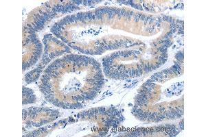 Immunohistochemistry of Human colon cancer using GNAZ Polyclonal Antibody at dilution of 1:25 (GNaZ anticorps)