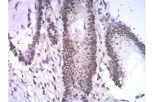 Immunohistochemical analysis of paraffin-embedded colon cancer tissues using ASH2L mouse mAb with DAB staining. (ASH2L anticorps  (AA 493-628))