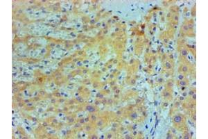 Immunohistochemical of paraffin-embedded Human live cancer tissue using ABIN7156047 at dilution of 1:200. (IL1A anticorps)