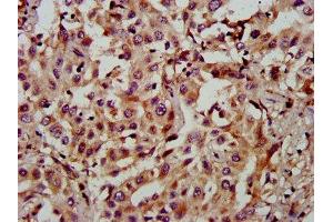 IHC image of ABIN7160745 diluted at 1:900 and staining in paraffin-embedded human liver cancer performed on a Leica BondTM system. (FAM174A anticorps  (AA 1-94))