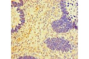 Immunohistochemistry of paraffin-embedded human ovarian cancer using ABIN7150987 at dilution of 1:100 (RNF2 anticorps  (AA 1-100))