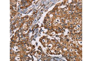 Immunohistochemistry of Human breast cancer using NDUFS1 Polyclonal Antibody at dilution of 1:35 (NDUFS1 anticorps)