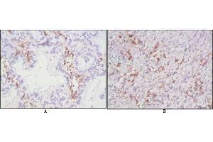 Immunohistochemical analysis of paraffin-embedded human lung cancer (A), lymphonodus tissue (B),showing cytomembrane localization using CD38 mouse mAb with DAB staining. (CD38 anticorps)