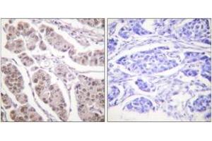 Immunohistochemistry analysis of paraffin-embedded human breast carcinoma tissue, using Histone H4 (Ab-5) Antibody. (Histone H4 anticorps  (AA 1-50))