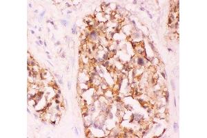 IHC-P: Crk antibody testing of human lung cancer tissue (Crk anticorps  (AA 2-246))