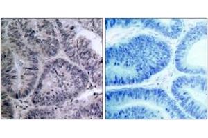 Immunohistochemistry analysis of paraffin-embedded human colon carcinoma tissue, using IKK-alpha (Ab-23) Antibody. (IKK alpha anticorps  (AA 15-64))