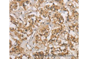 Immunohistochemistry of Human thyroid cancer using CASP3 Polyclonal Antibody at dilution of 1:30 (Caspase 3 anticorps)