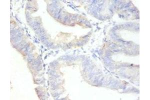 Immunohistochemistry of paraffin-embedded human endometrial cancer using ABIN7164742 at dilution of 1:100 (Ki-67 anticorps  (AA 3120-3256))