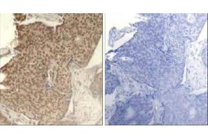 Immunohistochemical analysis of paraffin-embedded human breast carcinoma tissue using HDAC2 (Phospho- Ser394) antibody (E011191). (HDAC2 anticorps  (pSer394))