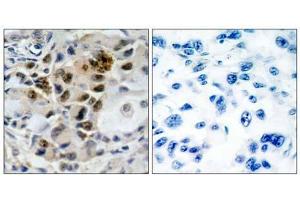 Immunohistochemical analysis of paraffin-embedded human lung carcinoma tissue, using AFX (Ab-197) antibody (E0 21162 ). (FOXO4 anticorps)