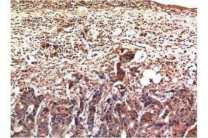Immunohistochemical analysis of paraffin-embedded Human Stomach Carcinoma Tissue using Ubiquitin Mouse mAb diluted at 1:200. (Ubiquitin anticorps)