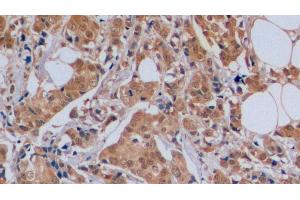 Detection of CDKN1B in Human Breast cancer Tissue using Polyclonal Antibody to Cyclin Dependent Kinase Inhibitor 1B (CDKN1B) (CDKN1B anticorps  (AA 1-198))