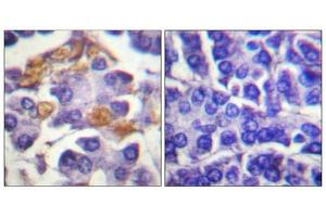 Immunohistochemical analysis of paraffin-embedded human pancreas tissue using Raf1 (Phospho-Tyr341) antibody (left)or the same antibody preincubated with blocking peptide (right). (RAF1 anticorps  (pTyr341))