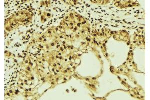 ABIN6276850 at 1/100 staining Human breast cancer tissue by IHC-P. (KPNA1 anticorps  (N-Term))
