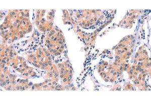 Immunohistochemistry of paraffin-embedded Human lung cancer tissue using VWF Polyclonal Antibody at dilution 1:50 (VWF anticorps)