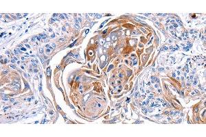 Immunohistochemistry of paraffin-embedded Human esophagus cancer tissue using CX3CL1 Polyclonal Antibody at dilution 1:30 (CX3CL1 anticorps)