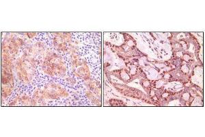 Immunohistochemical analysis of paraffin-embedded human ovary carcinoma (left) and breast carcinoma (right), showing cytoplasmic(ovary carcinoma) localization, cytoplasmic and nuclear (breast carcinoma) localization using SNCG mouse mAb with DAB staining. (SNCG (Breast Cancer-Specific Protein 1) anticorps)