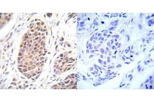 Immunohistochemical analysis of paraffin- embedded human breast carcinoma tissue using FOXO3A (Ab-253) antibody (E022020). (FOXO3 anticorps)