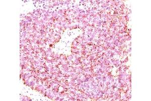 IHC testing of human small cell lung carcinoma stained with chromogranin A antibody cocktail (clones LK2H10 + PHE5 + CGA414). (Chromogranin A anticorps)