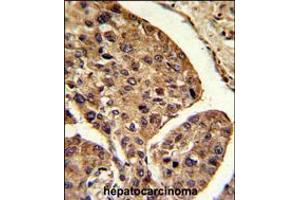 Formalin-fixed and paraffin-embedded mouse hepatocarcinoma reacted with PSME2 Antibody , which was peroxidase-conjugated to the secondary antibody, followed by DAB staining. (PSME2 anticorps  (AA 61-91))