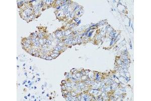 Immunohistochemistry of paraffin-embedded Human rectal cancer using EGFR Polyclonal Antibody at dilution of 1:100 (40x lens). (EGFR anticorps)