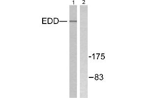 Immunohistochemistry analysis of paraffin-embedded human breast carcinoma tissue using EDD antibody. (UBR5 anticorps)