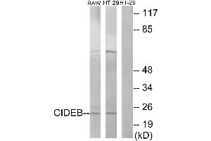 Immunohistochemistry analysis of paraffin-embedded human cervix carcinoma tissue using CIDEB antibody. (CIDEB anticorps  (Internal Region))