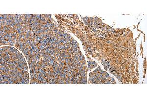 Immunohistochemistry of paraffin-embedded Human liver cancer tissue using CD151 Polyclonal Antibody at dilution 1:25 (CD151 anticorps)