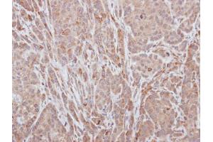 IHC-P Image Immunohistochemical analysis of paraffin-embedded A549 xenograft, using ADAMTS5, antibody at 1:100 dilution. (ADAMTS5 anticorps  (C-Term))