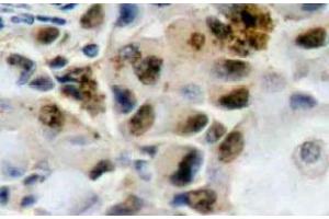 Immunohistochemistry (IHC) analyzes of FoxO4 antibody in paraffin-embedded human breast carcinoma tissue. (FOXO4 anticorps)