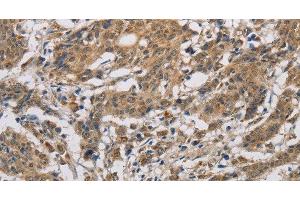 Immunohistochemistry of paraffin-embedded Human gastric cancer using CYCS Polyclonal Antibody at dilution of 1:50 (Cytochrome C anticorps)