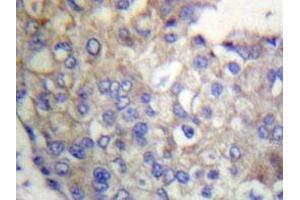 Immunohistochemistry analyzes of Flg antibody in paraffin-embedded human breast carcinoma tissue. (FGFR1 anticorps)