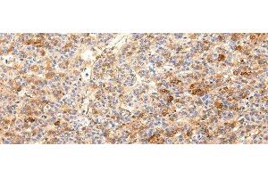 Immunohistochemistry of paraffin-embedded Human liver cancer using ZNF365 Polyclonal Antibody at dilution of 1/20 (ZNF365 anticorps)