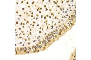 Immunohistochemistry of paraffin-embedded human uterine cancer using DDB1 Antibody. (DDB1 anticorps)