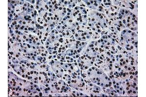 Immunohistochemical staining of paraffin-embedded Adenocarcinoma of colon tissue using anti-MAPK1mouse monoclonal antibody. (ERK2 anticorps)