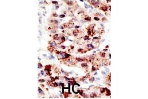 Formalin-fixed and paraffin-embedded human cancer tissue reacted with the primary antibody, which was peroxidase-conjugated to the secondary antibody, followed by AEC staining. (Ubiquitin anticorps  (AA 36-66))