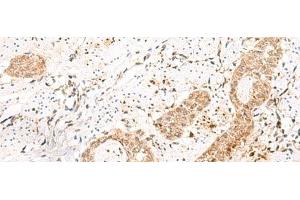 Immunohistochemistry of paraffin-embedded Human esophagus cancer tissue using PRKAG2 Polyclonal Antibody at dilution of 1:55(x200) (PRKAG2 anticorps)