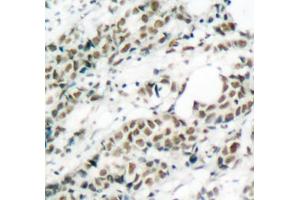 Immunohistochemistry of paraffin-embedded human breast carcinoma tissue, using Phospho-FOXO4-S197 antibody (ABIN3019724, ABIN3019725, ABIN3019726 and ABIN1681609). (FOXO4 anticorps  (pSer197))