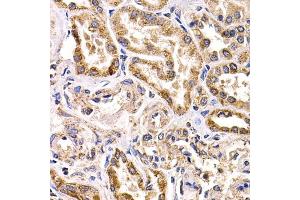 Immunohistochemistry of paraffin-embedded human kidney cancer using FZR1 antibody (ABIN5973232) at dilution of 1/200 (40x lens). (FZR1 anticorps)