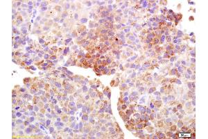 Formalin-fixed and paraffin embedded human bladder carcinoma labeled with Anti-Cancer/testis antigen 1B/1A Polyclonal Antibody, Unconjugated (ABIN1385260) at 1:200 followed by conjugation to the secondary antibody and DAB staining. (Testis Antigen 1 (AA 75-180) anticorps)