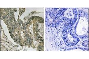 Immunohistochemistry analysis of paraffin-embedded human colon carcinoma tissue, using ALDOC Antibody. (ALDOC anticorps  (AA 61-110))